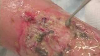 Biofilm Removal