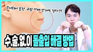 수술없이 돌출입 해결하는방법 "수술, 교정 너무 비싸서 비용이 부담스러웠던 분들 필수시청"