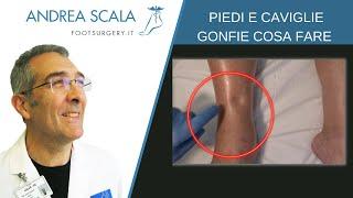 Piedi e caviglie gonfie: quali sono le cause? | Come effettuare la manovra della fovea