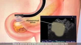 Endoscopic Ultrasound