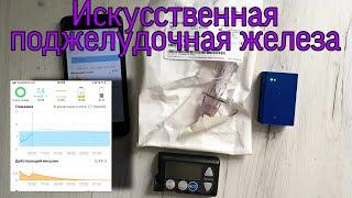 THE REVOLUTIONARY TREATMENT OF DIABETES MELLITUS TYPE 1.  ARTIFICIAL PANCREAS