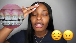 Braces/Frenectomy Update | Starring Shameka