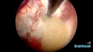 Brainbook case 4: The colloid cyst