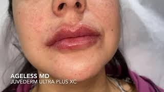 Lip augmentation treatment BY AGELESS MD DR.TSAY