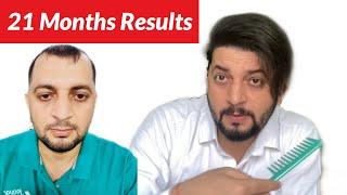 My 21 Months Hair Transplant results