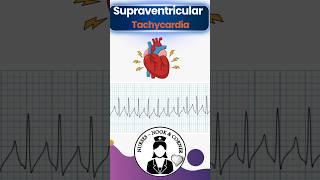 Supra ventricular Tachycardi  #shorts #heart #nursing