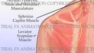 Trigger Point Injections