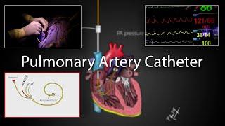 Pulmonary artery catheter (Swan-Ganz Catheter) placement and physiology