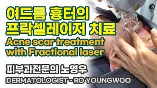 ■ 여드름 흉터의 텐셀 레이저 치료 ■ 청담오라클피부과 (acne scar treatment with tencell laser)