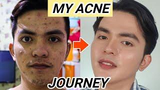 PAANO AKO KUMINIS - MY ACNE JOURNEY (MJ GARCIA PEREZ)