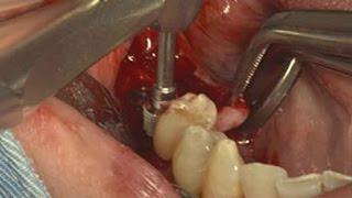 Immediate implantation using Dentium SuperLine system on post. mandible (Live)