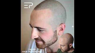 World Class Scalp Micropigmentation in Toronto Canada