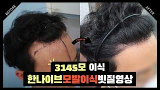 #모발이식후기 수술 후 7개월 빗질 영상 [절개3145모] I 한나이브성형외과