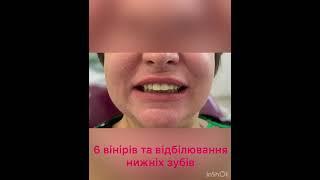 виниры днепр винилы установка виниров виниловые зубы коронки на передние зубы, зубные протезы виниры