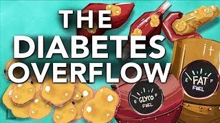 Obesity & Diabetes Explained: The Overflow Phenomenon