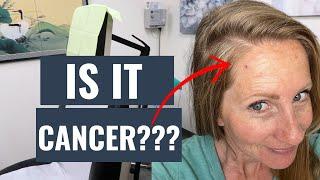 Is it CANCER? | My recent skin cancer journey.