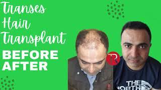 HAIR TRANSPLANT BEFORE-AFTER Transes Hair Transplant Turkey