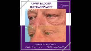 #blepharoplastyExpert