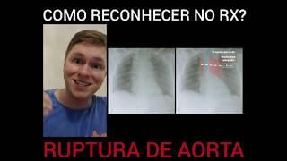 RUPTURA DE AORTA | COMO RECONHECER NO RX?