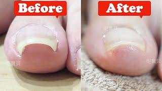 Gummy nail treatment for thumb｜Foot problem nail treatment case｜Gummy nail, can nail