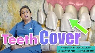 Dental Veneer (Cover) in Smile Kochi dental