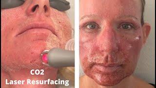 CO2 Laser Resurfacing ~ CO2RE