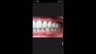 Before and after
