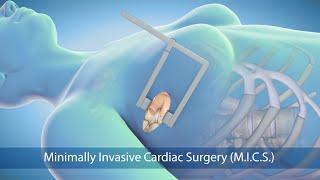 Medical Animation: Minimally Invasive Cardiac Surgery (MICS) at Sarasota Memorial Hospital