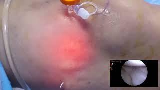 Unedited Live surgery video of Outside in Meniscal repair