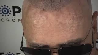 Top Scalp Micropigmentation