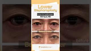 Two reasons why you're not satisfied with your lower blepharoplasty!