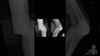 Knee Dislocation #meded #doctor #emergencymedicine  #medicalschool #orthopedicsurgeon #trauma