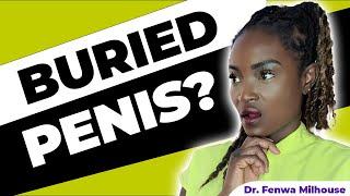 CANT SEE YOUR PENIS? (BURIED PENIS) | Dr. Milhouse