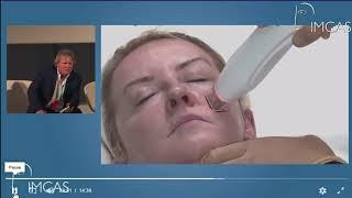 Demonstration of Onyx RF Microneedling by Dr. Patrick Treacy