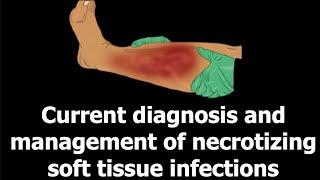 Current diagnosis and management of necrotizing soft tissue infections