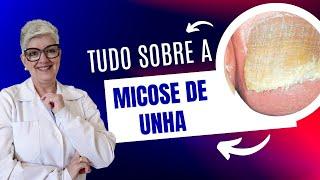 Tudo Sobre MICOSE DE UNHA Da Prevenção ao Tratamento