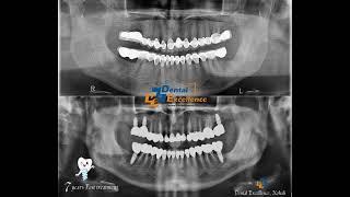 Bite Into Life Again: How Dental Implants Can Restore Your Culinary Joy