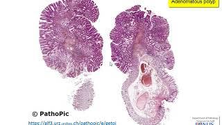 Colon: Familial Adenomatous Polyposis