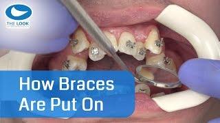 How braces are put on - AMAZING ! - Now with 12 month - Progress : https://goo.gl/jXaY15