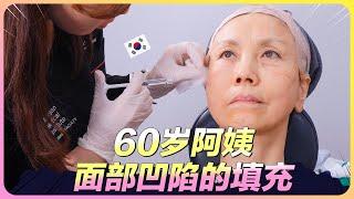 60的韩国阿姨面部凹陷怎么办？看医生如何给您变魔术！ (feat:特秀恩碧明洞店）