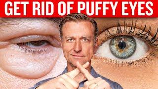 Get Rid of Puffy Eyes for Good with Dr. Berg's Proven Techniques