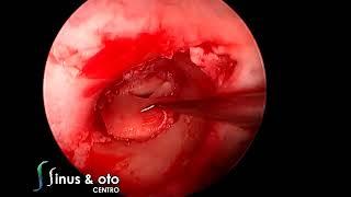 Pac-Man Tympanoplasty