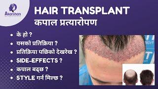 HAIR TRANSPLANT IN NEPAL कपाल प्रत्यारोपण | What you should know | Nepal