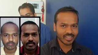 Hair Transplant Patients results Plastic Surgery Clinic Malad Mumbai Dr.Umang Kothari.