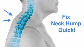 Fix Your Neck Hump | Buffalo Hump | Dowagers hump