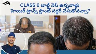 Hair Transplant In Hyderabad | Best Results Surgeon & Center Of Hair Transplant Surgery In Hyderabad