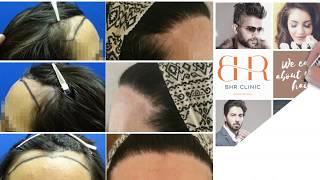 Female Hair Restoration - 2000 Grafts (0 to 8 Months) | FUE Hair Transplant Result (BHR Clinic)