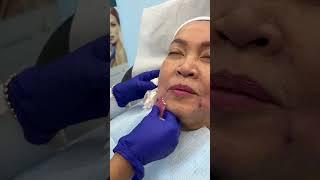 Smooth Threads Treatment by Nurse Ami - Ageless MD