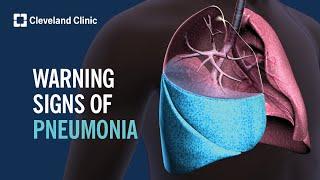 4 Warning Signs of Pneumonia