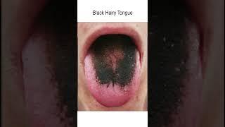 "Normal" Tongue Variations - Do not HAVE to be treated though some may choose to pursue treatment